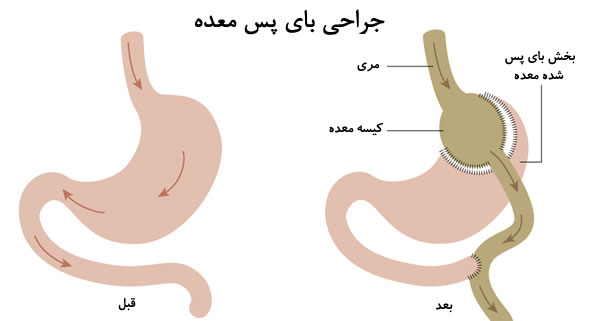 جراحی بای پس معده